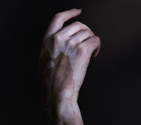 Vitiligo Activity background